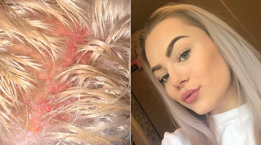Woman claims she was left with oozing blisters after getting hair bleached  | Fox News