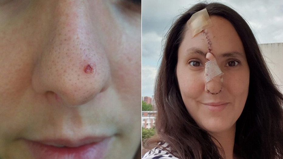 Mom Loses Tip Of Nose After Dismissing Skin Cancer Symptom As