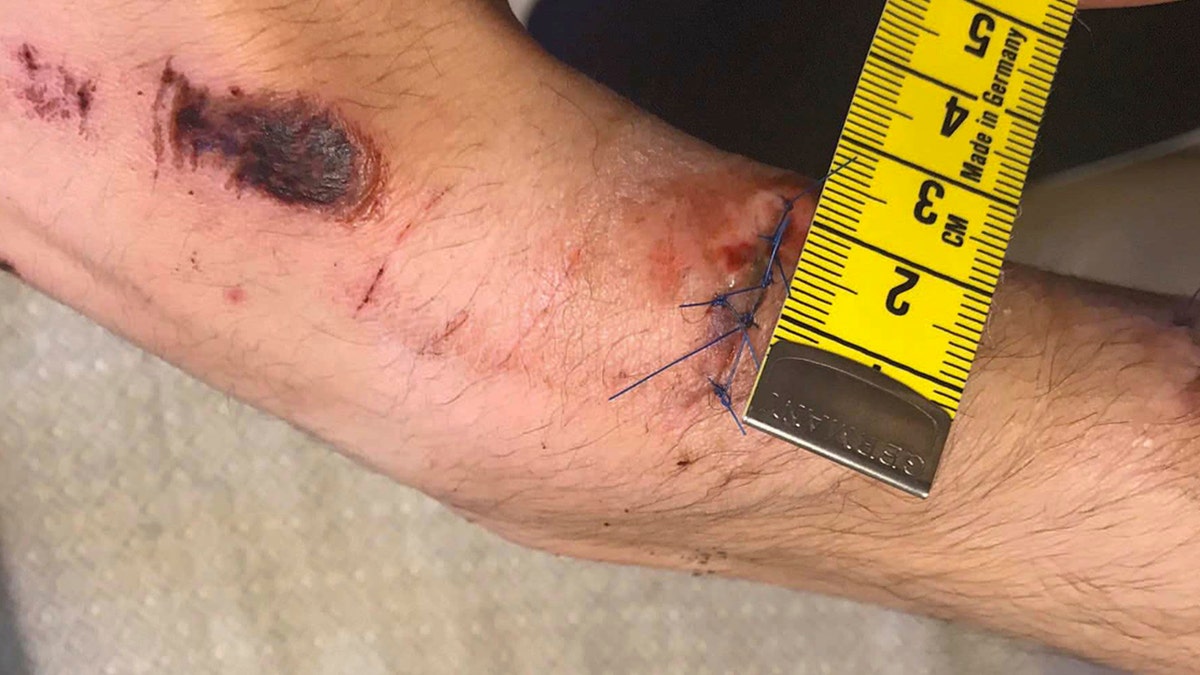 This undated photo made available by the Swedish Police via the Swedish Court, shows an injury sustained by Mustafa Jafari, the alleged victim involved in a fight with rapper A$AP Rocky.