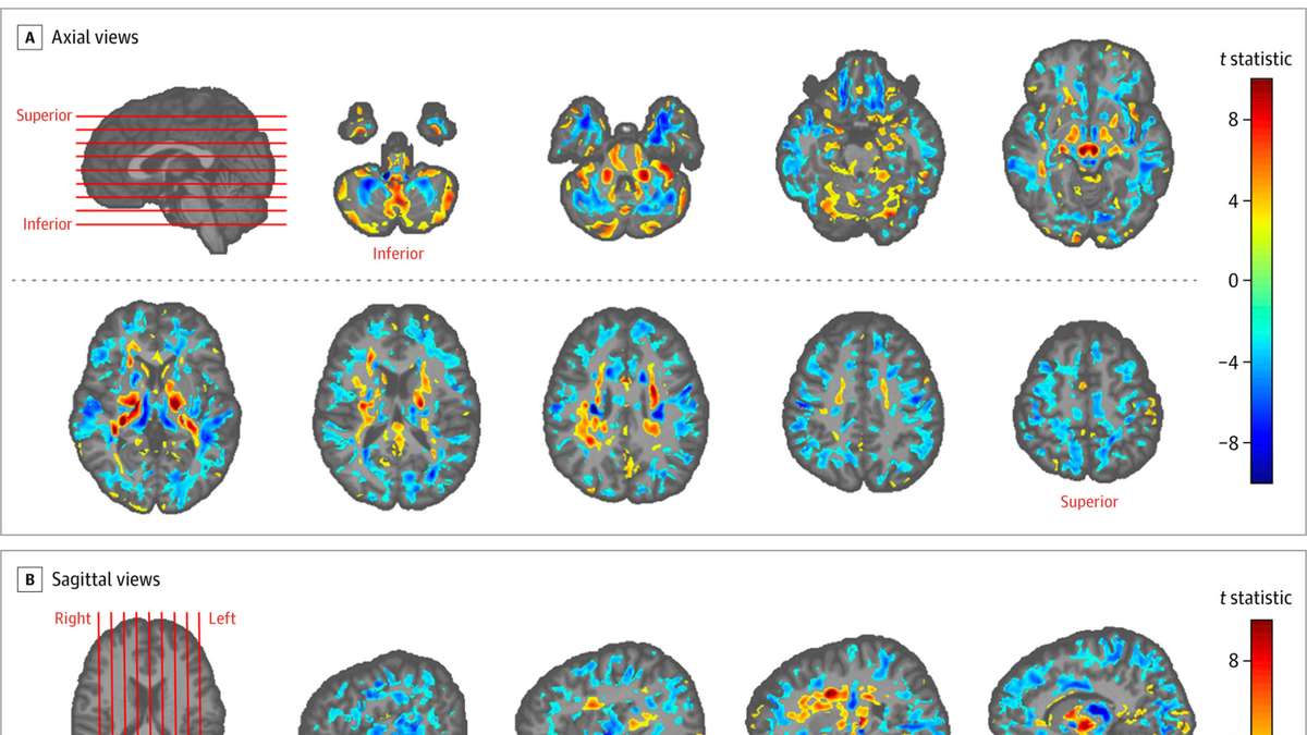 This image provided by the American Medical Association in July 2019 shows the amount of differences between brain scans of patients, U.S. diplomats who developed concussion-like symptoms after working in Cuba, and a control group. Between late 2016 and May 2018, several U.S. and Canadian diplomats in Havana complained of health problems from an unknown cause. One U.S. government count put the number of American personnel affected at 26. (American Medical Association via AP)