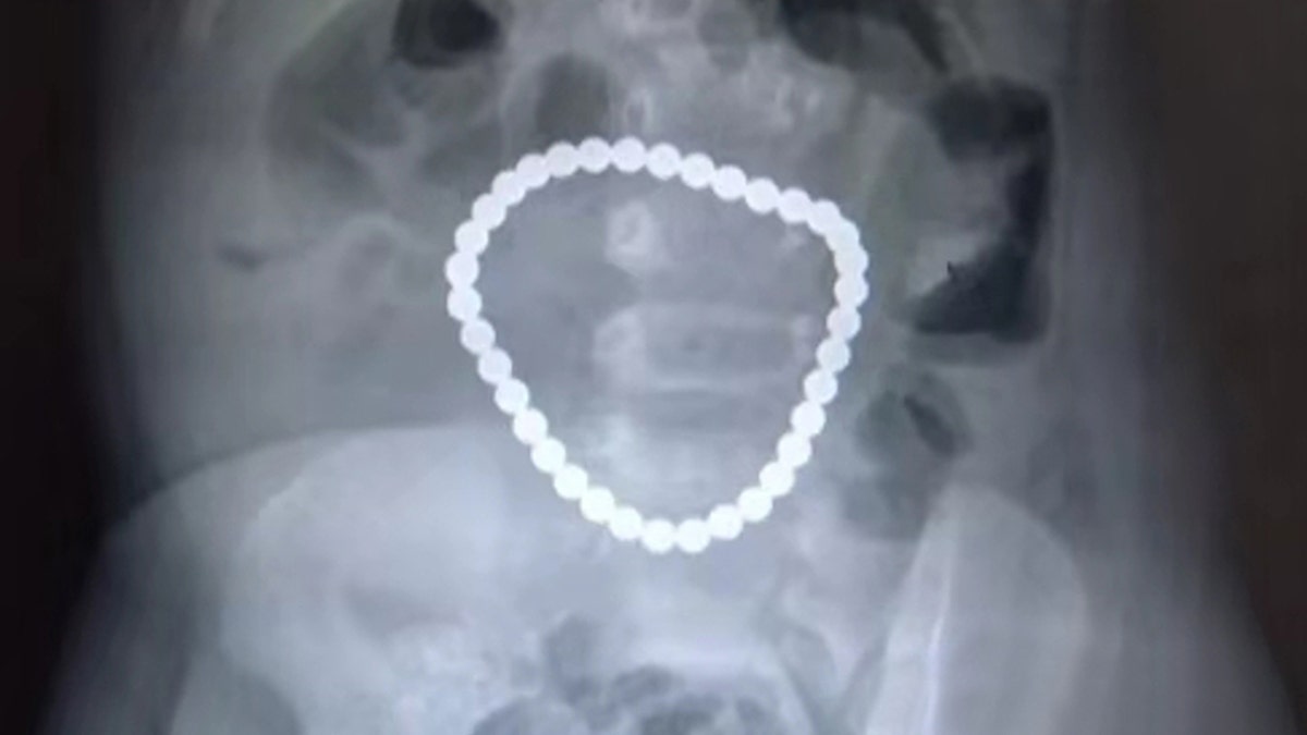 An X-ray revealed that the magnets had attached to each other in her body.