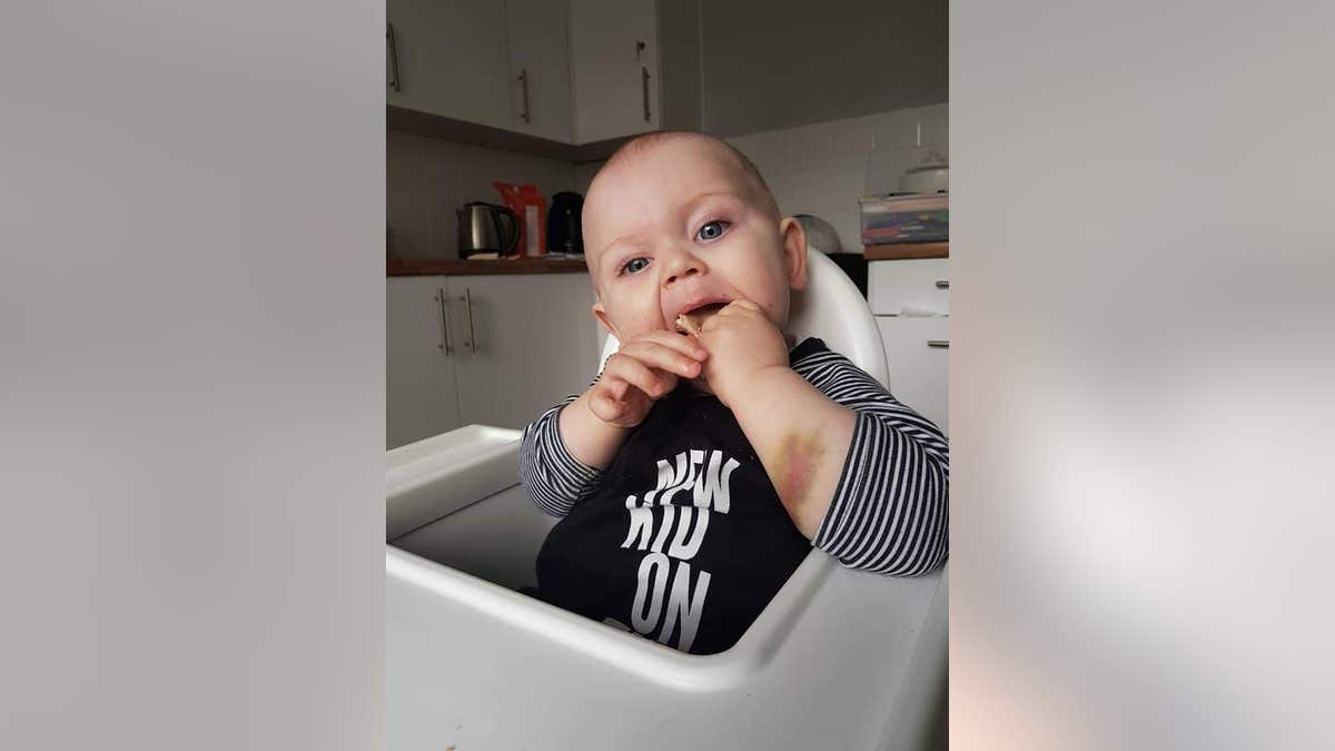 Jack Fearns, now 2, has a rare blood condition called hemophilia.