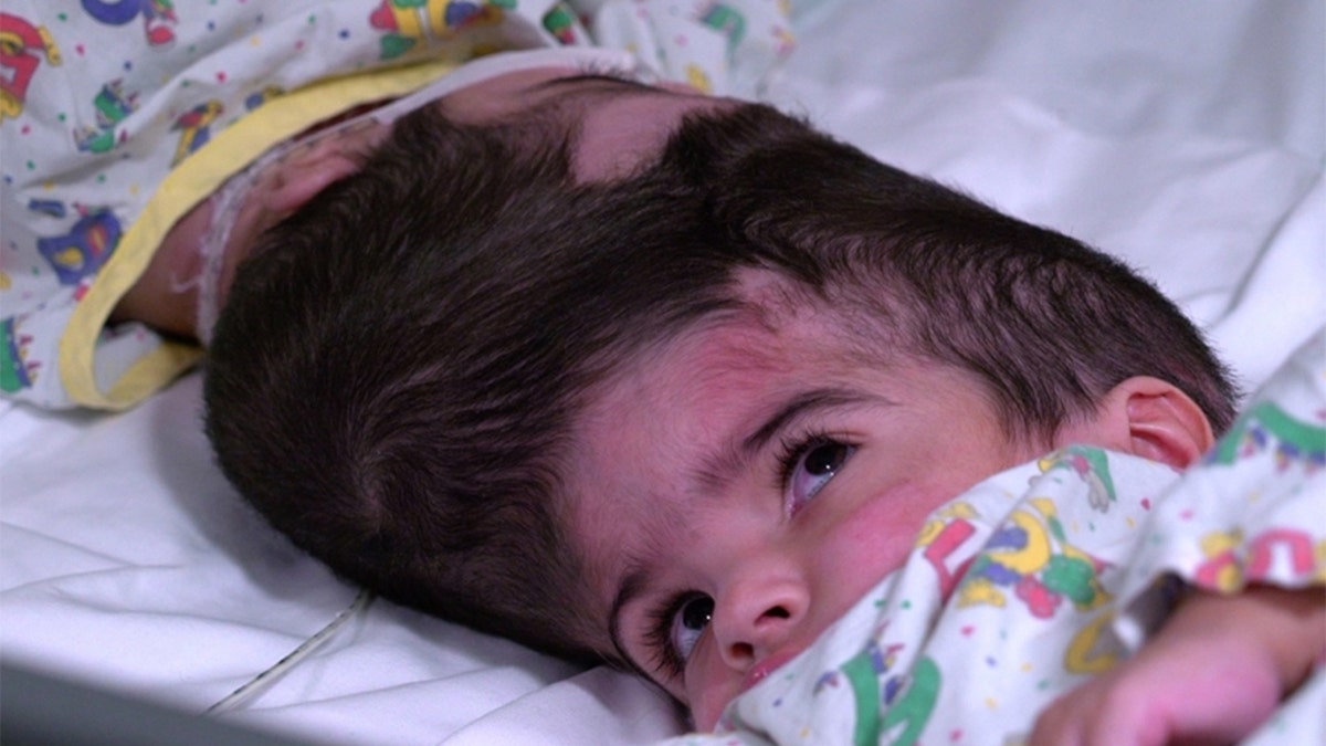 The twins, who were born in Jan. 2017, are considered craniopagus, meaning they are joined at the head.