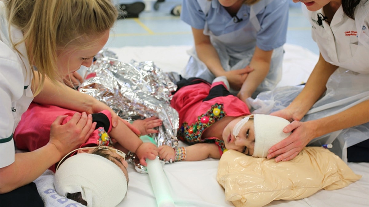 They were separated over the course of several procedures beginning in October and were finally released from the hospital in July.