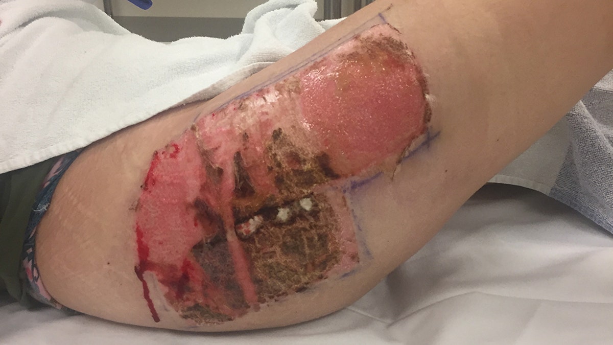 After 32 days of an open wound, they were able to use skin from her thigh to cover the area on her neck.