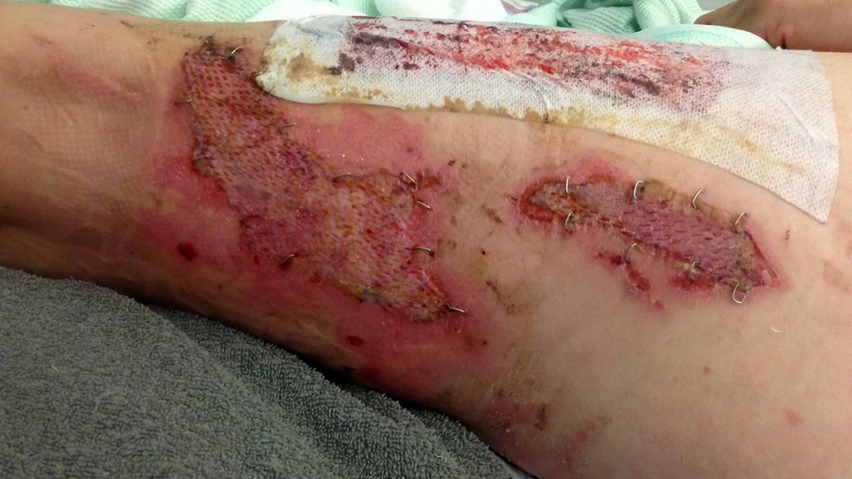 The fabric of his pants had to be peeled off his wounds, which then developed an infection.