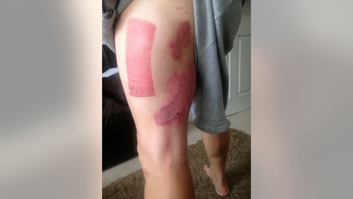 Charlton hasn't returned to work yet, but said he is grateful to have his legs after the ordeal.