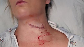 South Dakota woman survives freak lawn mower accident that left her neck sliced open