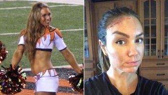 Ex-cheerleader's skin cancer left her with gaping hole in head