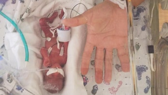 Iowa 'miracle baby' born weighing 13 ounces