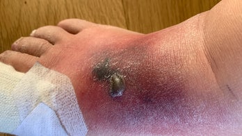 Spider bite leaves UK man with crater-like hole in foot: 'Most gruesome thing I had ever seen'