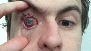 Man blinded by parasite after showering with contacts in