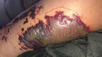 'Hot tub' infection nearly cost Indianapolis mom her leg on family vacation, she claims