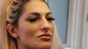 Washington woman dubbed the 'Botox Bandit' wanted for skipping out on cosmetic bills