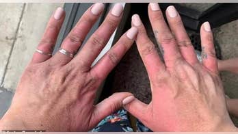 Woman's blistering 'margarita burns' like 'being cooked from the inside out'