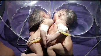 Conjoined twins born sharing same heart in India: 'Separation is almost impossible'