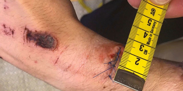 This undated photo made available by the Swedish Police via the Swedish Court, shows an injury sustained by Mustafa Jafari, the alleged victim involved in a fight with rapper A$AP Rocky.