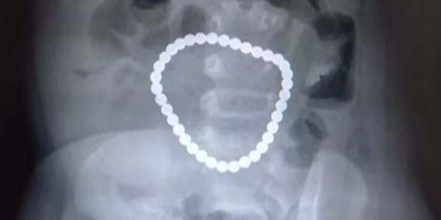 An X-ray revealed that the magnets had attached to each other in her body.