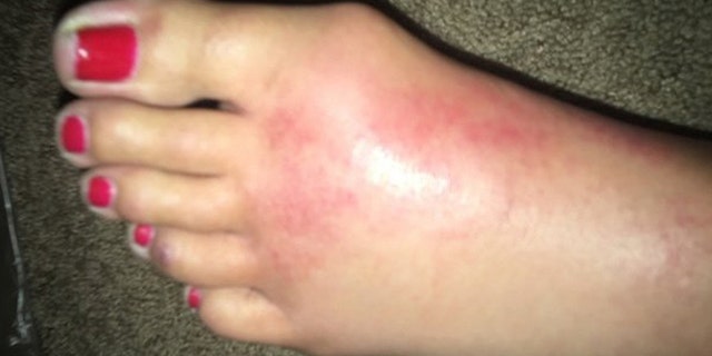 Guastucci said while celebrating the Fourth of July she suddenly felt a severe pain in her foot followed by swelling.