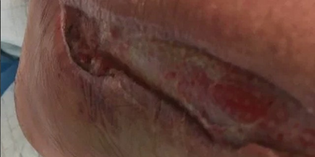 She said that within two minutes it swelled to a size she knew required medical attention, and she was rushed to Kaiser Permanente.