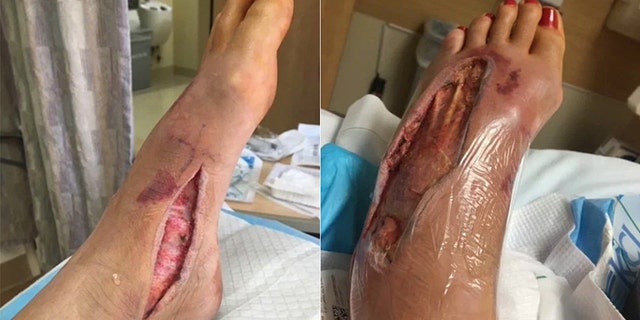 Guastucci said she spent nearly two weeks in the hospital as doctors worked to stop the infection from spreading further.
