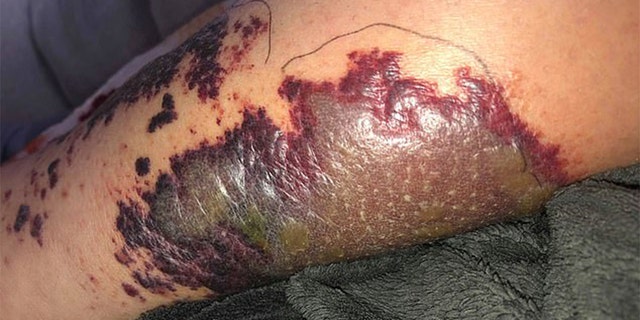 At one point her doctors told her they could not rule out the amputation.