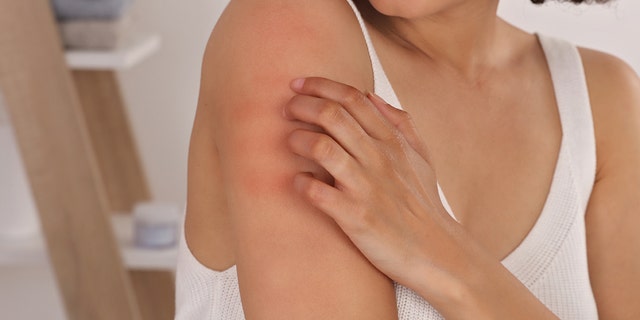 woman scratches arm
