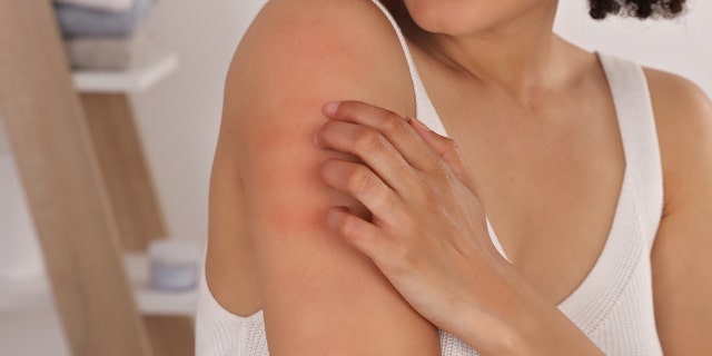 People should avoid scratching insect bites. Scratching can cause further inflammation and infection, doctors say.