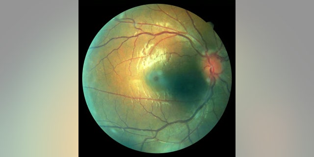 A CT scan revealed a colloid cyst behind her left eye.