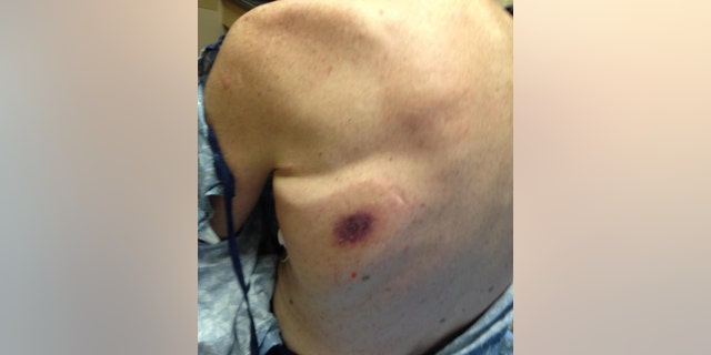 Cheryl Bennett Wiygul said her father (pictured) noticed a black spot on his back less than a day after being in Florida waters.