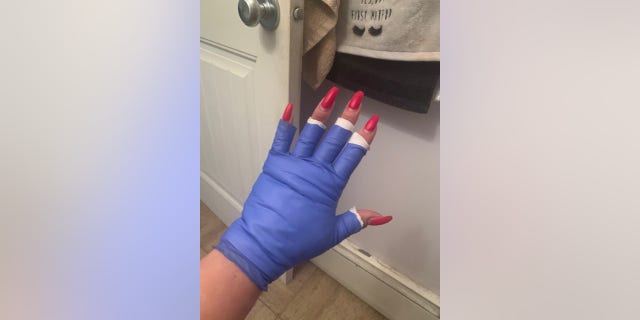 Prepchuk said she had to keep her hands wrapped and bandaged for several days as the burns healed. (Amber Prepchuk)