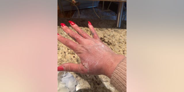 “I woke with blisters forming in between my fingers and on the tops of my hands," she said. (Amber Prepchuk)