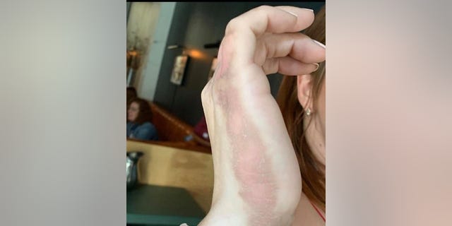 The 34-year-old now has dark streaks -- known as post-inflammatory pigmentation -- on her hands from the burns.