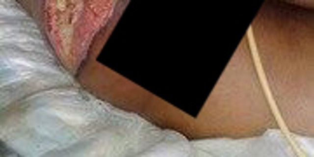 A immature woman, Nelma, pang a vast infection after descending over. After some-more than a year but using water, Nelma’s encampment temporarily perceived using water. She was so vehement when she found out that she ran out of her residence to spin on her dry hose. In her excitement, she fell and cut her self nearby her butt. Having entrance to usually squatter toilets and soiled water, a cut became infected. She is in unfortunate need of antibiotics, a surgery, and afterwards medicines to assistance her recover.