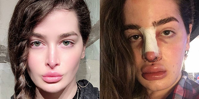 Kristen Snider, 28, first went under the knife in 2010, and has had over 20 procedures since including getting several ribs removed to achieve her "dream look."