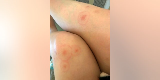 A so-called "bullseye" rash is a common sign of Lyme disease.