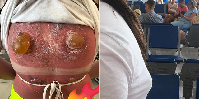 One 16-year-old girl from England was horrifically sunburned on her back while snorkeling in Cuba during a family vacation. Now recovering, the teen has since taken to Facebook to warn others of the summer sun’s dangers in a post that has since gone massively viral with over 20,000 comments to date.