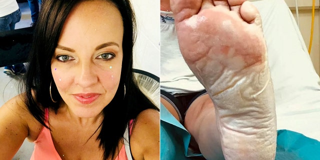 Jenkins, qui était à la plage avec sa famille, a déclaré qu'ils avaient cessé de faire du barbecue plus de quatre heures avant sa blessure.