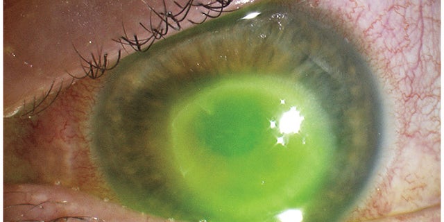 The woman was nearly blinded by the infection.