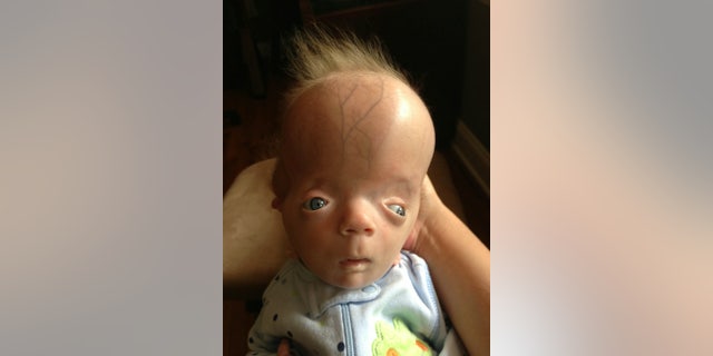 Doctors have begun referring to his diagnoses as "Graysons Syndrome."
