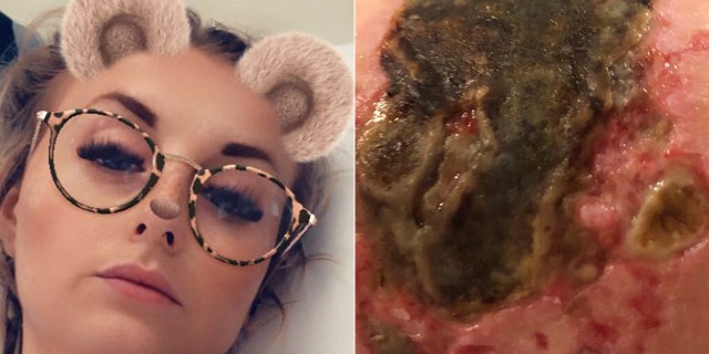 She said her skin started tingling within seconds, and that when she got to the hospital efforts to wash the solution off failed.