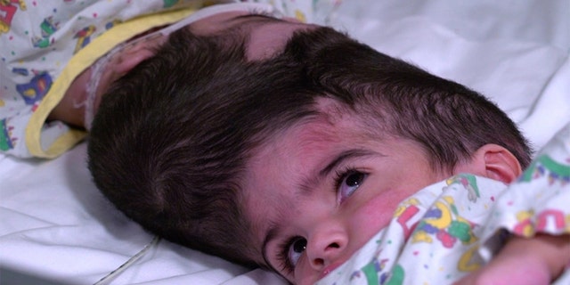 The twins, who were born in Jan. 2017, are considered craniopagus, meaning they are joined at the head.