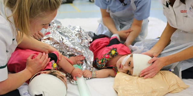 They were separated over the course of several procedures beginning in October and were finally released from the hospital in July.