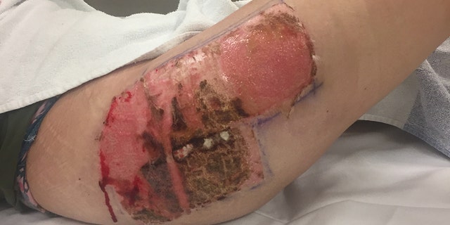 After 32 days of an open wound, they were able to use skin from her thigh to cover the area on her neck.