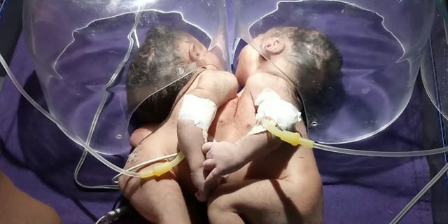 The twin girls, who have not been named yet, are joined from their chests to their stomachs.