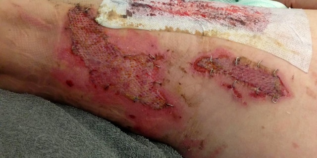 The fabric of his pants had to be peeled off his wounds, which then developed an infection.