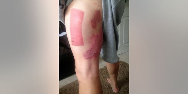Charlton hasn't returned to work yet, but said he is grateful to have his legs after the ordeal.