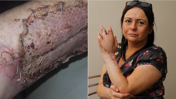 Woman Loses Finger Could Ve Died After Cat Scratch Triggers