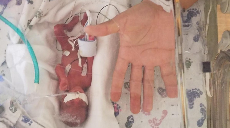 Miracle Baby' Born at Just 10 Ounces Finally Gets to Go Home - ABC News