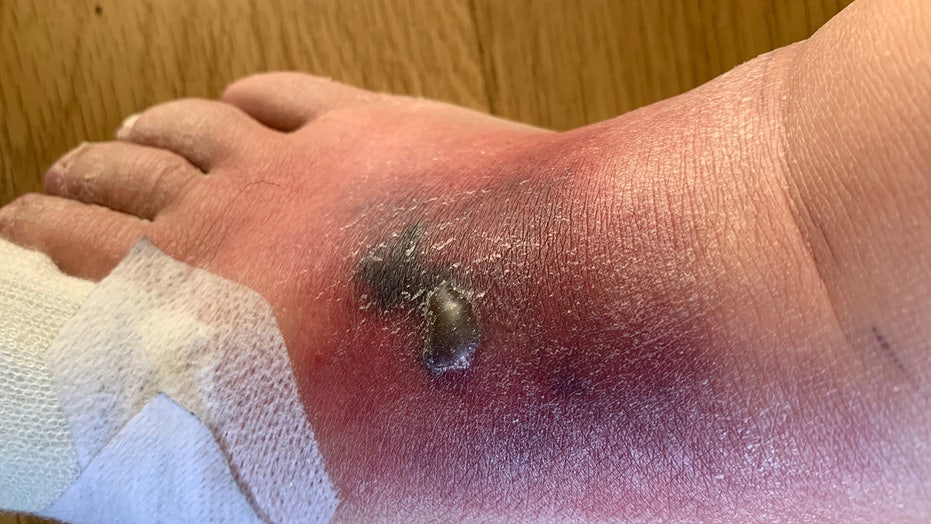 Spider Bite Leaves Uk Man With Crater Like Hole In Foot Most